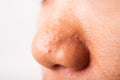 Woman large pores have freckles cheek oily, acne pimple on nose