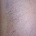 Woman leg close up with beginning varicose veins