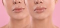 Woman before and after lip correction procedure. Banner design Royalty Free Stock Photo