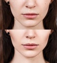 Woman before and after lip filler injections.