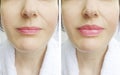 Woman lips before and after correction augmentation difference injection Royalty Free Stock Photo