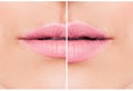 Woman lips before and after lip filler injections.