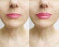 Woman lips before and after magnification beautiful Royalty Free Stock Photo