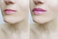 Woman lips before and after perfect correction augmentation difference injection Royalty Free Stock Photo