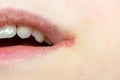 Woman lips skin with Herpes Labialis virus close up. Royalty Free Stock Photo