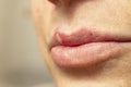 woman lips with a virus herpes pustule, manifestation of herpes, Royalty Free Stock Photo