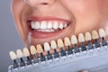 Woman Matching Shade Of The Implant Teeth