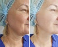 Woman neck wrinkles facelift before after treatment removal