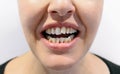 Woman open mouth with crooked teeth