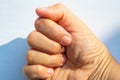 Woman peeled index finger and scar skin on hand, White background, Close up & Macro shot, Asian Body skin part, Healthcare concept