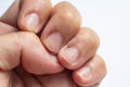 Woman peeled middle finger and wound skin on left hand, White background, Close up