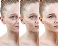 Woman with phase of skin rejuvenation before and after treatment. Royalty Free Stock Photo