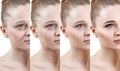 Woman with phase of skin rejuvenation before and after treatment.