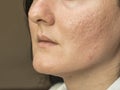 Woman with problematic skin and acne scars. Pigmentation on face woman. Royalty Free Stock Photo