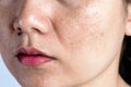 Woman with problematic skin and acne scars. Problem skincare and health concept. Wrinkles melasma Dark spots freckles dry skin and Royalty Free Stock Photo