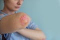 Woman with psoriasis. Health allergy skin care problem, Psoriasis vulgaris. Joints affected by psoriatic arthritis Royalty Free Stock Photo