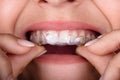 Woman Putting Transparent Aligner In Teeth