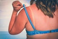 Woman with red sunburned shoulder - sunburn concept