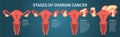 Four stages of ovarian cancer dark blue scheme
