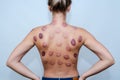 Woman`s back with hematomas marks after taking cupping therapy. After vacuum cans