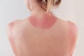 Woman`s back skin hurt from sun burn.