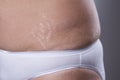 Woman`s belly with stretch marks closeup Royalty Free Stock Photo