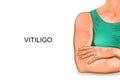 A woman`s body affected by vitiligo