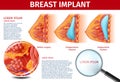 Woman Breast with Implant Insertion Medical Banner Royalty Free Stock Photo