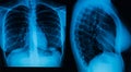 A woman`s chest x-ray in two projections Royalty Free Stock Photo
