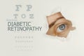 Woman`s eye looking trough teared hole in paper, eye test with words Diabetic Retinopathy