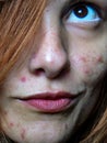 Woman`s face with severe acne / skin condition Royalty Free Stock Photo