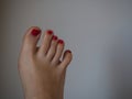 Woman`s feet with abnormal twisted shape of little finger, foot problems.