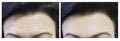 Woman`s forehead before and after procedures Royalty Free Stock Photo