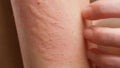 A woman's hand scratches a inflamed place on the skin covered with blisters