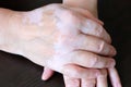 Woman`s hands folded. The skin is stained with vitiligo.