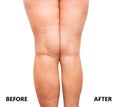 Woman`s legs before and after weight loss Royalty Free Stock Photo