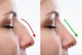 Woman`s Nose Before And After Plastic Surgery