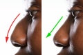 Woman`s Nose Before And After Plastic Surgery