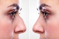 Woman`s Nose Before And After Plastic Surgery Royalty Free Stock Photo