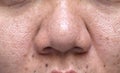 Woman`s problematic skin , acne scars ,oily skin and pore, dark spots and blackhead and whitehead on the face