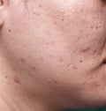 Woman`s problematic skin , acne scars ,oily skin and pore, dark spots and blackhead and whitehead on the face Royalty Free Stock Photo