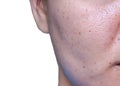 Woman `s problematic skin , acne scars ,oily skin and pore, dark spots and blackhead and whitehead on the face