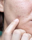 Woman`s problematic skin , acne scars ,oily skin and pore, dark spots and blackhead and whitehead on the face Royalty Free Stock Photo