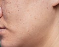 Woman `s problematic skin , acne scars ,oily skin and pore, dark spots and blackhead and whitehead on the face Royalty Free Stock Photo