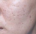 Woman`s problematic skin , acne scars ,oily skin and pore, dark Royalty Free Stock Photo