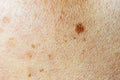 Woman`s problematic skin pore and dark spots
