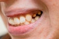 Woman\'s teeth before prosthetics. Full mouth