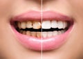 Woman's teeth before and after whitening