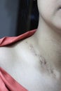 A woman with a scar near the neck