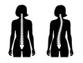 Scoliosis flat vector illustration